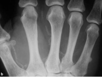 /album/calcifica%c3%a7%c3%a3o%20vascular/calcificacao-ii-png1/